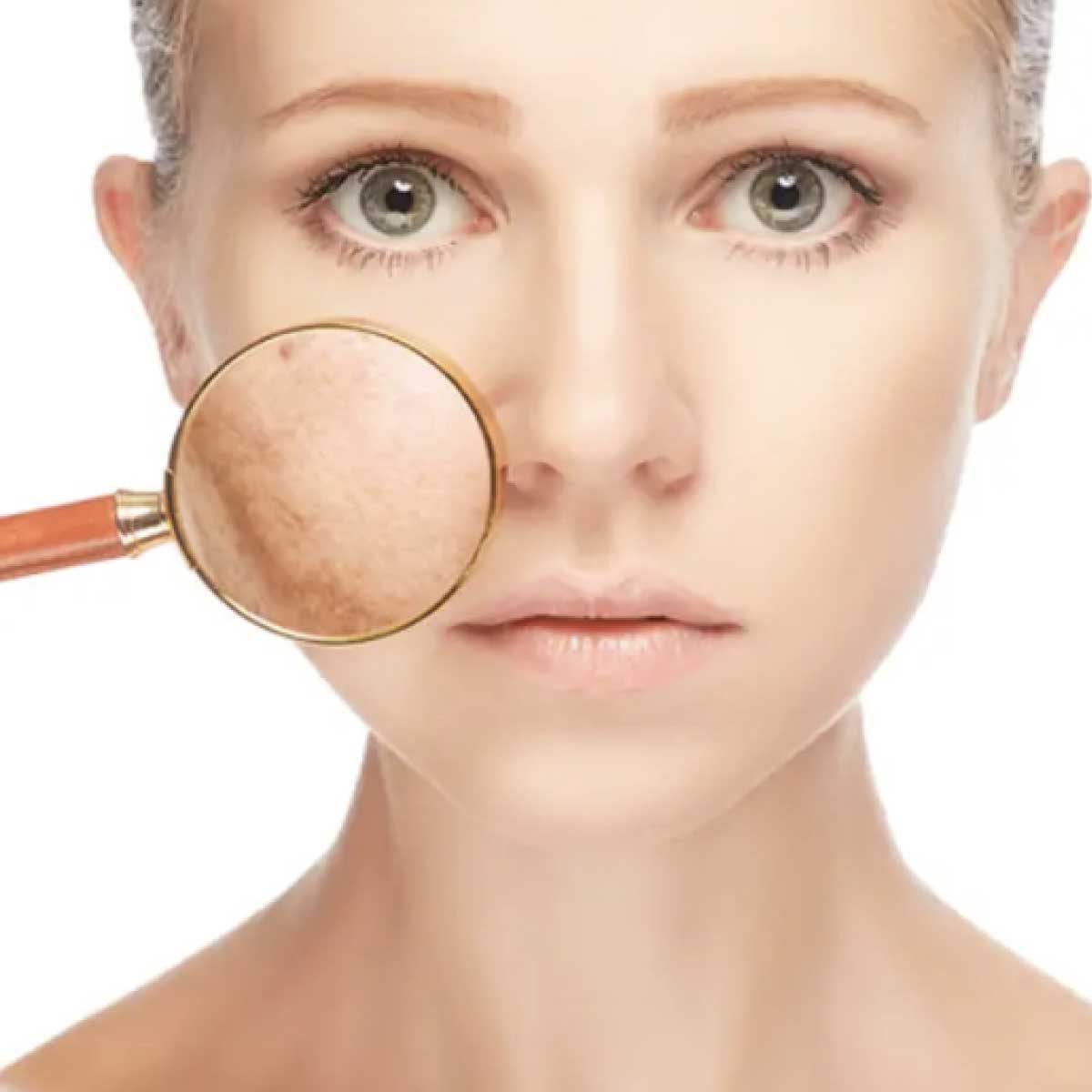 Skin Peel