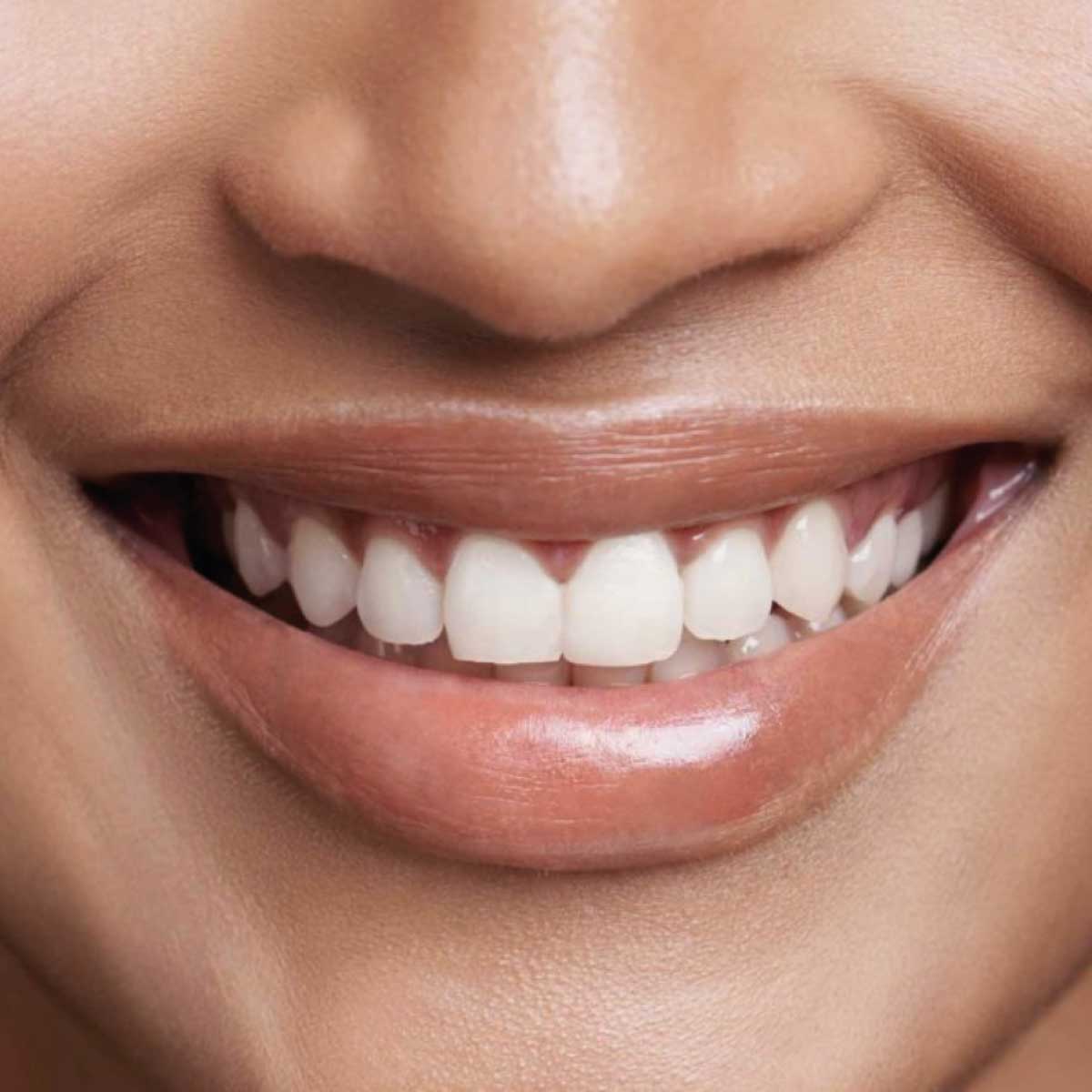 Lip Filler