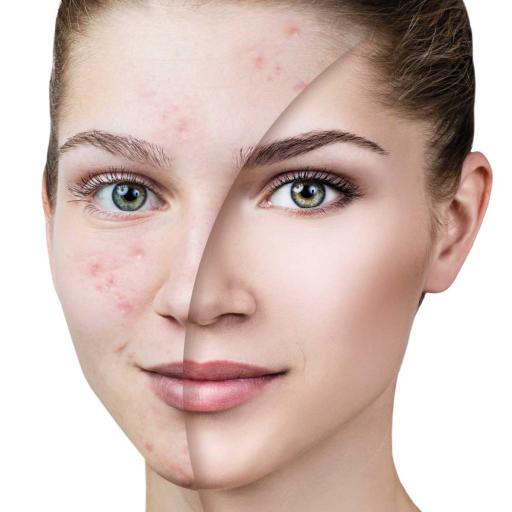 Acne Vulgaris or common acne