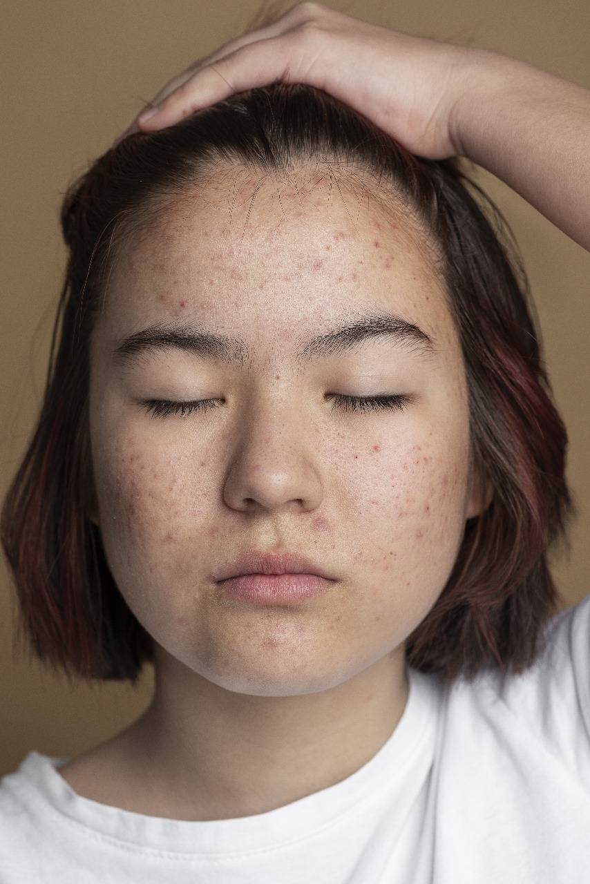 Acne