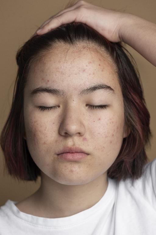 Acne